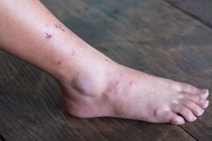 cura de diabetes gangrena en los pies cura de diabetes gangrena en los pies