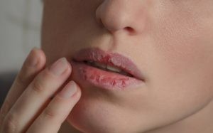 Queilitis actinica